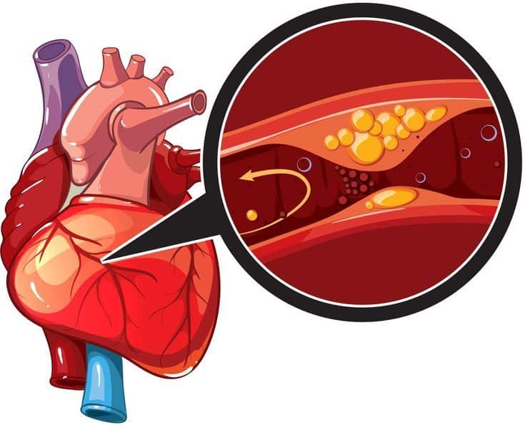 plaque buildup in arteries restricting blood flow. A plant-based diet can help reduce arterial plaque and lower high blood pressure naturally.