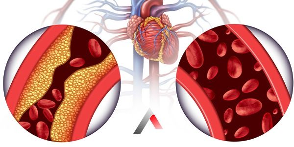 Arterial plaques developing if K2 is deficient